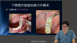 【裁断済】【即日発送】科学的根拠に基づいた ビジュアル下顎埋伏智歯抜歯 科学的根拠に基づいたビジュアル下顎埋伏智歯抜歯_NoLink