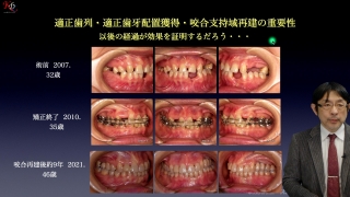 知っておこう！咀嚼機能の再建と補綴的補完治療の対応方法の画像です。