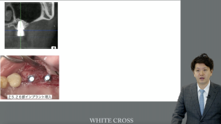 失敗しらずのフルマウス治療〜割れないプロビの作り方〜の画像です。