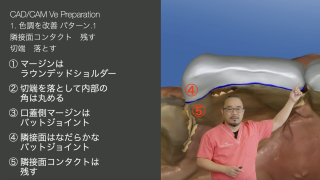 一回のチェアタイムで完結させる前歯部審美治療〜口腔内スキャナーではじめるOne Visit Veneer〜の画像です。