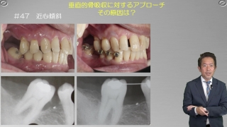 歯周治療における咬合力のコントロール 歯周治療における咬合力のコントロール | WHITE CROSS