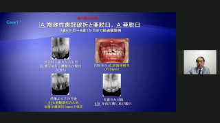 小児における外傷歯への対応 ー歯冠破折と歯根破折についてーの画像です。