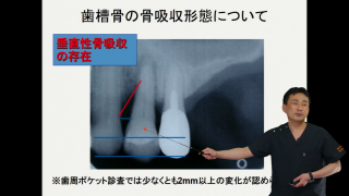 戦略的歯周組織再生治療〜CTデータと抗菌薬を応用する〜の画像です。