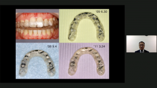 ペリオの重症例・難症例をきれいに治す、長持ちさせる〜ブラキシズム、TCHを伴う症例への対処〜の画像です。