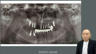 研修歯科医のためのインプラント治療クリニカル・パールの画像です。