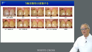 MIDの理念に沿った根面う蝕のマネジメント戦略 | WHITE CROSS