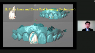 インプラント治療がスムーズに進むデジタルコピーによる補綴方法 ―口腔内スキャナーを口腔外で使用する新しいテクニックとは―の画像です。