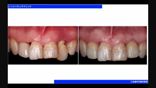 GBRにまだ縫合は必要だとお考えですか？減張しないGBR！の画像です。