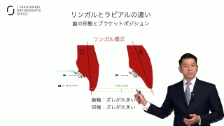 リンガル矯正とアライナー型矯正の基礎と応用の画像です。