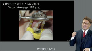 GPのためのマウスピース矯正～できるできないの判断基準とは～の画像です。