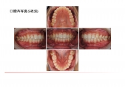 口腔内写真5枚法の画像です。