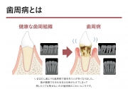 歯周病とはの画像です。
