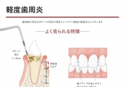 軽度歯周炎の画像です。