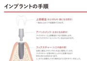 インプラントの手順の画像です。