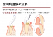 歯周病の治療の流れの画像です。