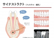 サイナストラクト（フィステル・瘻孔）の画像です。