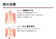 根の治療の説明の画像です。