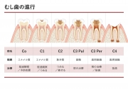 むし歯の進行の画像です。