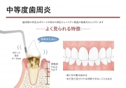 中等度歯周炎の画像です。