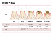 歯周病の進行の画像です。