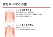 被せる治療の説明の画像です。