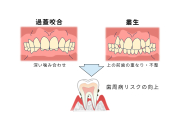 不正咬合と歯周病の関連性をどう説明する？（Perio Box監修）の画像です。
