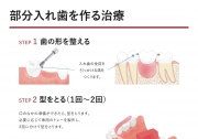 部分入れ歯（パーシャルデンチャー）を作る治療の画像です。
