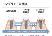 インプラント周囲炎の画像です。