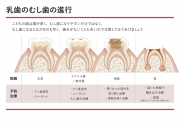 乳歯のむし歯の進行の画像です。